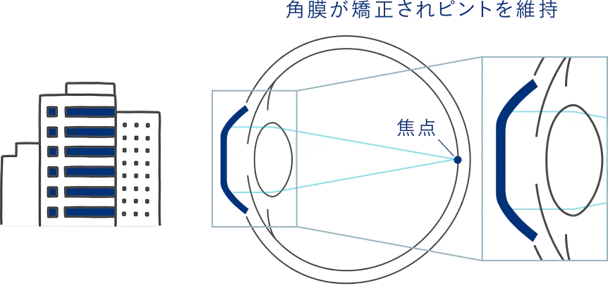 角膜が矯正されピントを維持