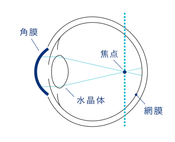 装用前(近視の状態)