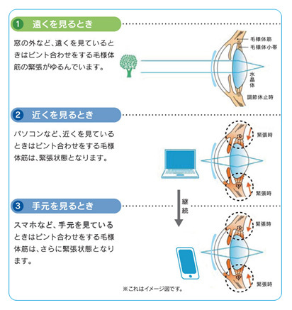 毛様体筋を酷使すると目が疲れる 1.遠くを見るとき 窓の外など、遠くを見ているときはピント合わせをする毛様体筋の緊張がゆるんでいます。2.近くを見るとき パソコンなど、近くを見ているときはピント合わせをする毛様体筋は緊張状態となります。3.手元を見るとき ケータイなど、手元を見ているときはピント合わせをする毛様体筋は、さらに緊張状態となります。