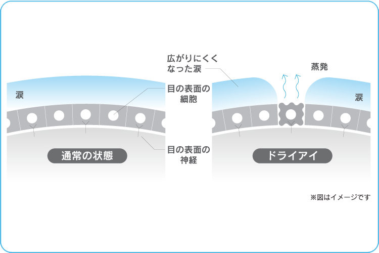 通常の状態とドライアイ