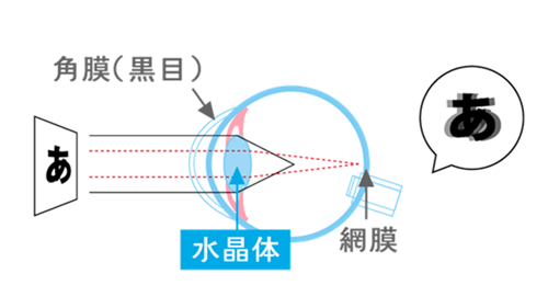 乱視