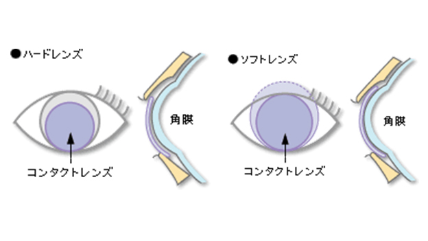 上眼瞼で支える場合