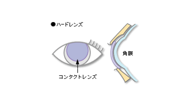 下眼瞼で支える場合