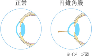正常角膜と円錐角膜のイメージ