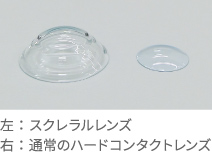 スクレラルレンズのイメージ