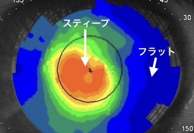 円錐角膜眼の角膜トポグラフィー赤い部分が円錐状に突出している