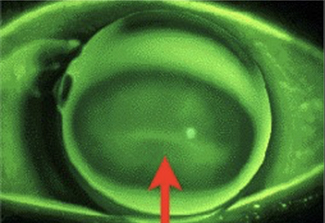 球面HCLによる円錐角膜のフィッティング例（２点接触法）円錐の頂点への接触が強い