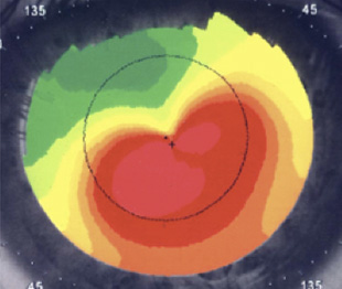 角膜トポグラフィーのカラーマップ