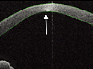前眼部OCTによる円錐角膜の断面写真