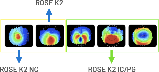 様々な円錐角膜へ対応が可能に“ローズK”から“ローズK2”へ