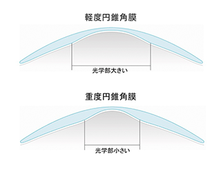 後面光学部径が変動